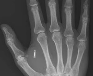 Swedish woman gets microchip 'key' implanted in hand