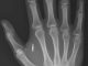 Swedish woman gets microchip 'key' implanted in hand