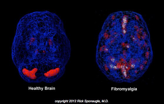 Fibromyalgia