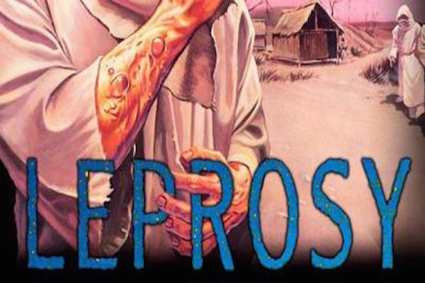 leprosy