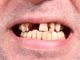 A new study proves that fluoride does not create healthy teeth as Brits are said to have better teeth than Americans