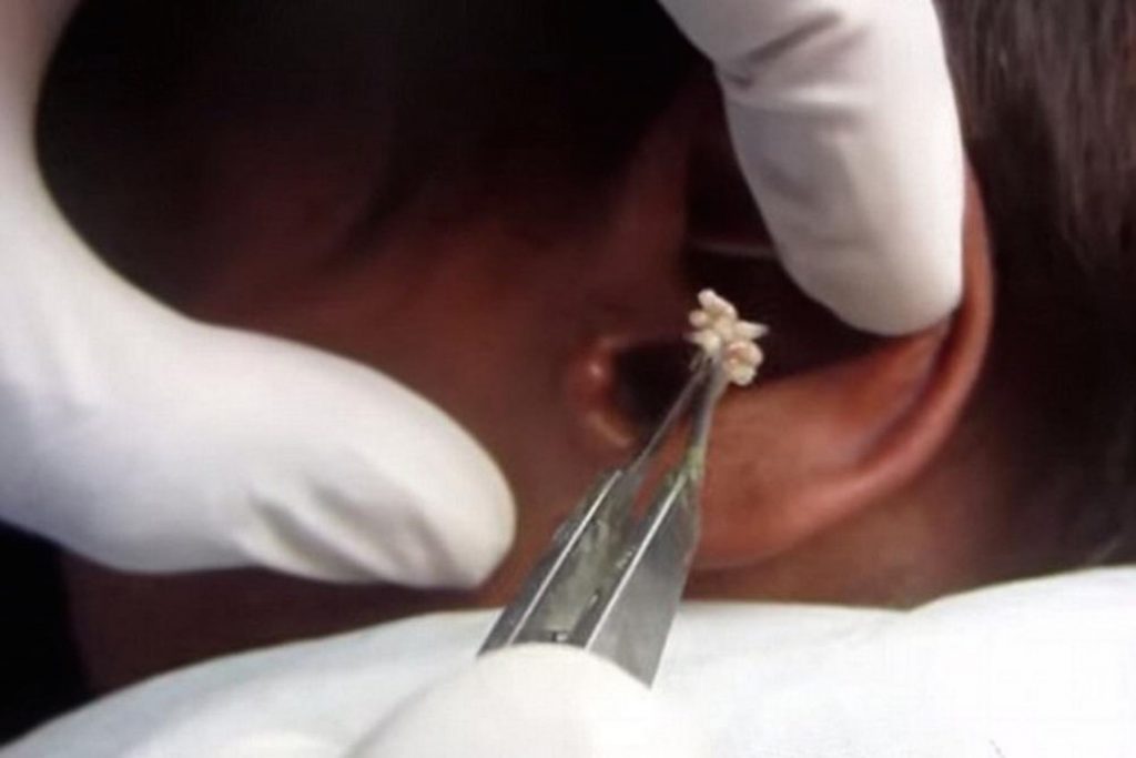 Maggot therapy reintroduced into hospitals