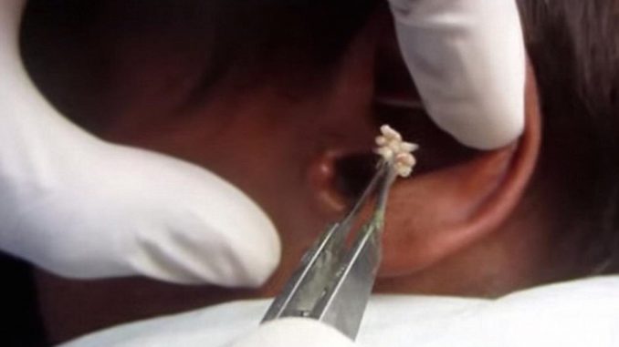 Maggot therapy reintroduced into hospitals