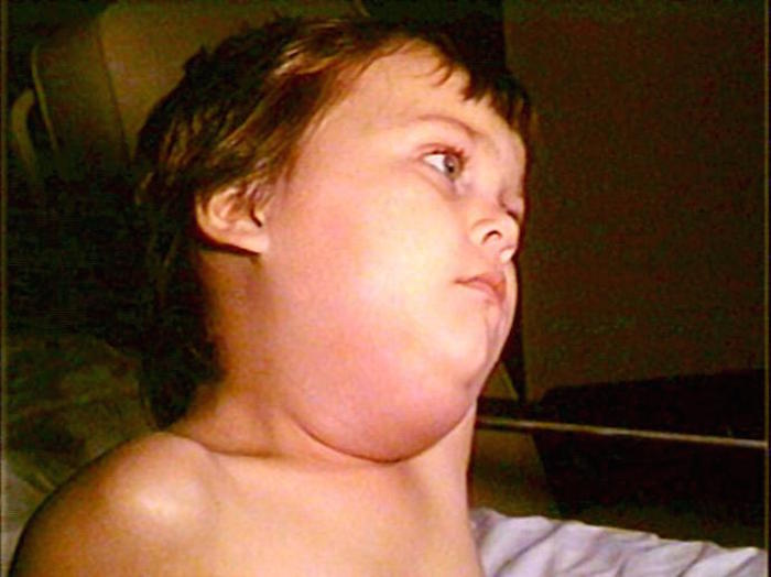 Mumps outbreak in Arkansas is only affecting unvaccinated children