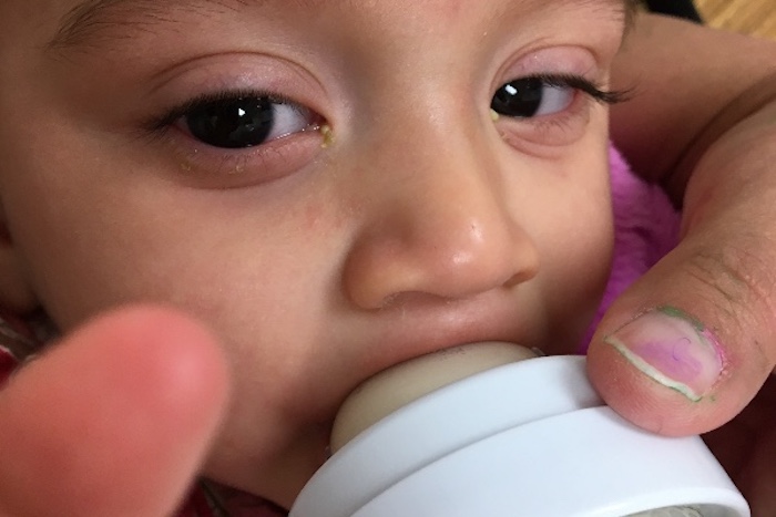 Negligent doctor accidentally vaccinated and injured baby with gardasil, then the government blamed the mother and removed the child from her care.