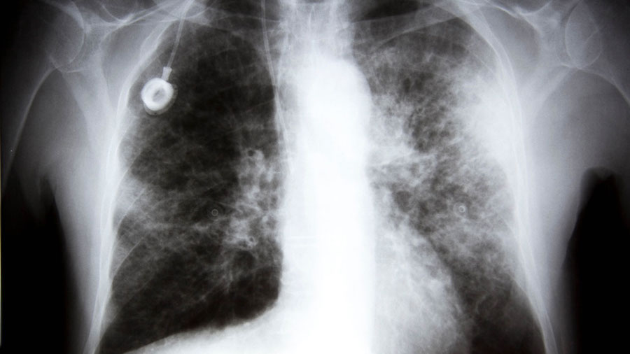 Ohio State University say that chemotherapy enables cancer to spread from the breast to the lungs