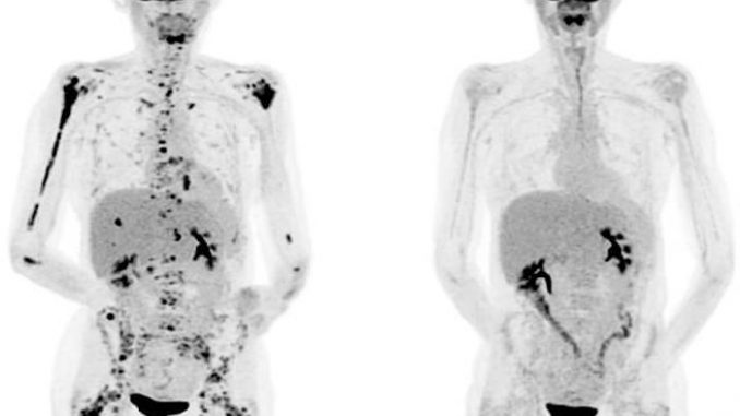 Scientists unveil new cancer therapy that cures tumors within days