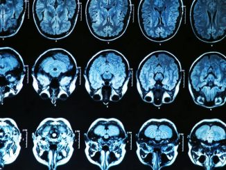 Parasite found to cause Alzheimer's, Epilepsy, Cancer