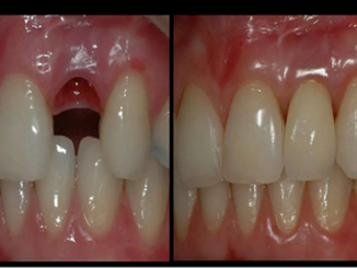 Fillings could be consigned to the dustbin of history after scientists discovered an Alzheimer's drug can encourage teeth to regrow.