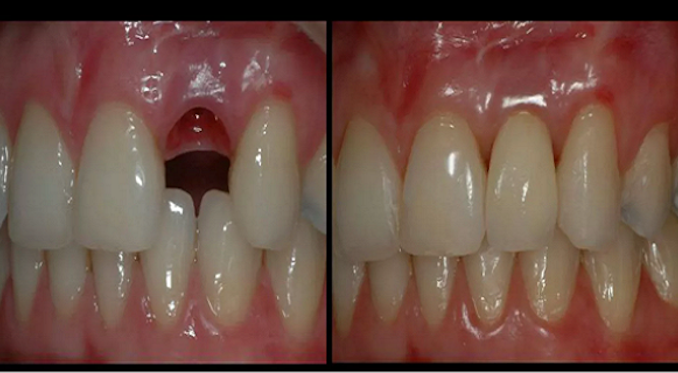 Fillings could be consigned to the dustbin of history after scientists discovered an Alzheimer's drug can encourage teeth to regrow.