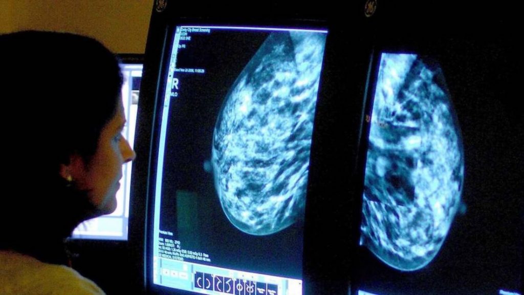 Women with high cholesterol less likely to develop breast cancer, scientists say