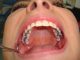 New Zealand ban amalgam fillings due to serious public health concerns