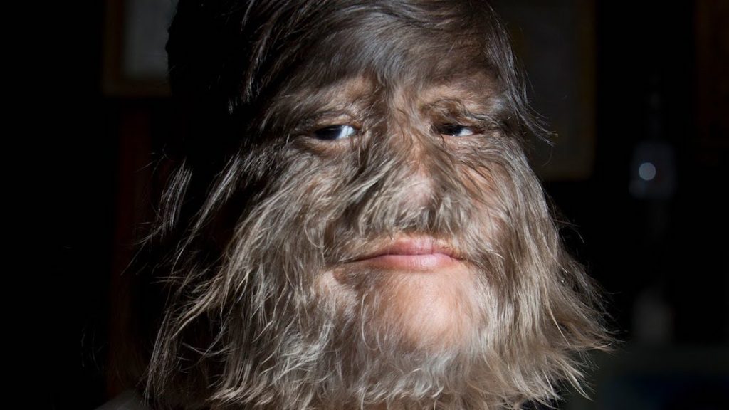 Supatra “Natty” Susuphan, 17, who suffers from Ambras Syndrome, also known as Werewolf Syndrome, has discovered shaving and found a husband.