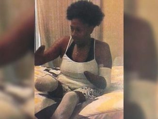 A Charlotte mother was left without hands and feet after a botched surgery, after initially needing only "routine" Fallopian tube surgery.