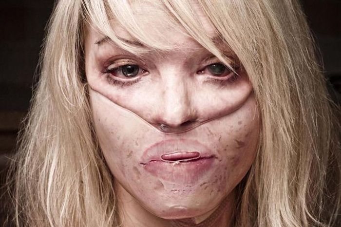 UK judge says acid attacks becoming epidemic in London