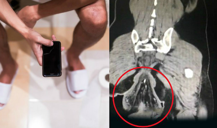 A man who had been sitting on the toilet playing games for hours was hospitalized after noticing a ball-sized lump dangling from his anus.