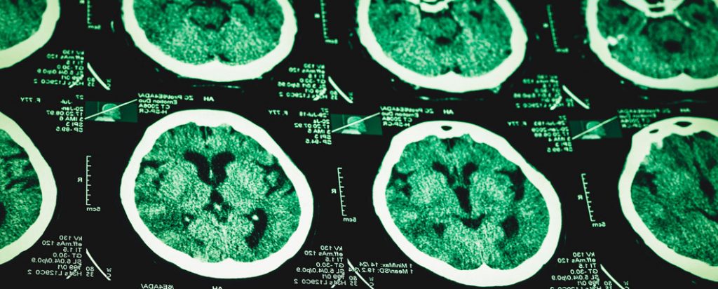 Adderall causes brain damage, study warns