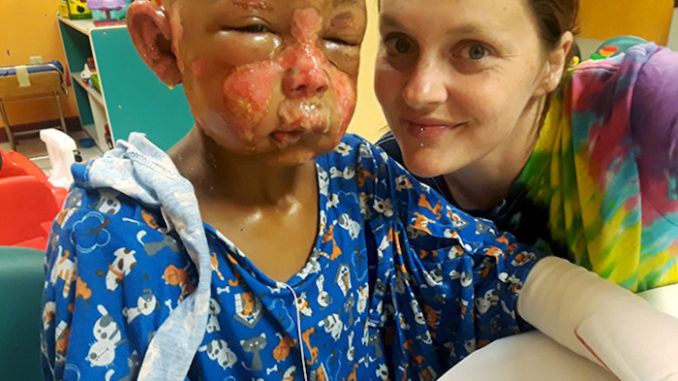 A 7-year-old boy has been hospitalized with severe burns after another boy doused him with nail polish remover and set him on fire.