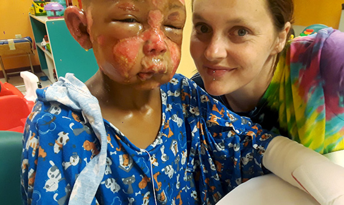 A 7-year-old boy has been hospitalized with severe burns after another boy doused him with nail polish remover and set him on fire.