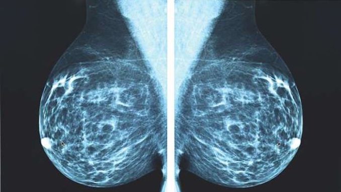 X-ray Mammography is accelerating cancer epidemic, top doctor warns