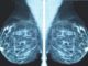 X-ray Mammography is accelerating cancer epidemic, top doctor warns