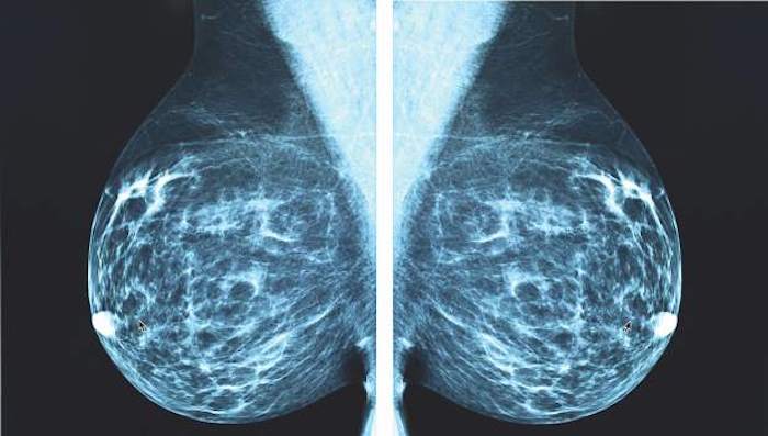 X-ray Mammography is accelerating cancer epidemic, top doctor warns