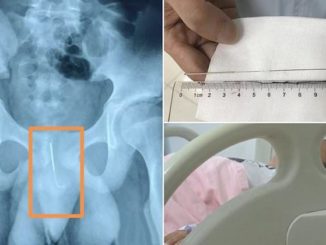 A 12-year-old Chinese was transported to hospital for emergency surgery after inserting a 4-inch acupuncture needle into his penis.