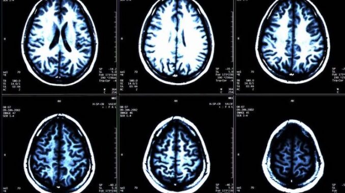 'Mystery' neurological illness sweeps across Canada