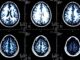 'Mystery' neurological illness sweeps across Canada