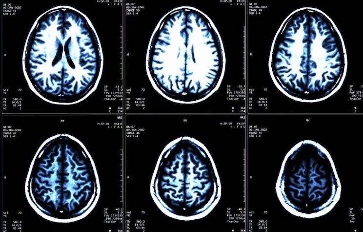 'Mystery' neurological illness sweeps across Canada