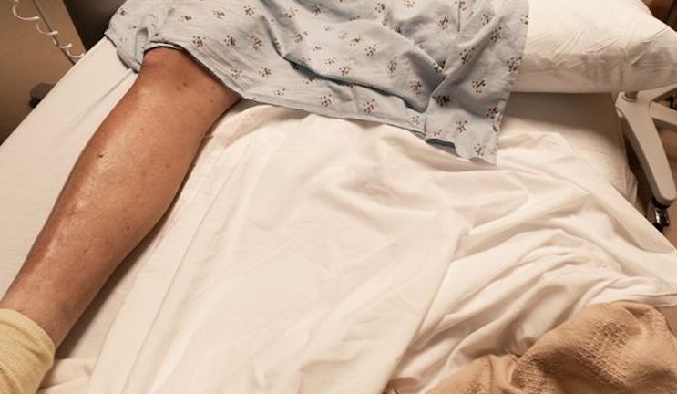 Doctors amputate man's leg due to Covid-19 vaccine injuries