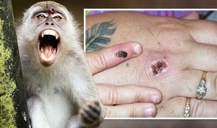 Monkeypox outbreak caused by climate change, scientists claim.