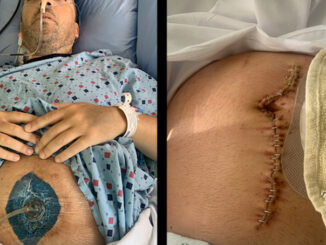 Man loses 6 feet of small intestine due to covid jab injury
