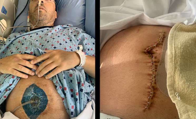 Man loses 6 feet of small intestine due to covid jab injury