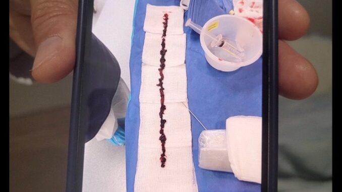 10 inch blood clot removed from vaccinated person - video