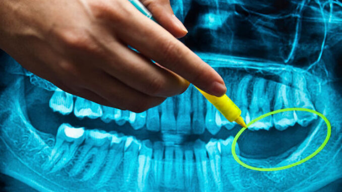 Dentists warn that vaxxed patients are beginning to lose their teeth