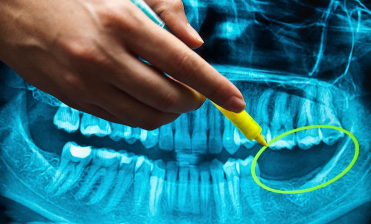 Dentists warn that vaxxed patients are beginning to lose their teeth