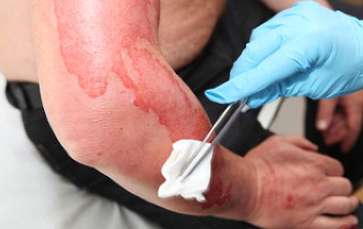 Thousands of vaccinated patients are reporting that their skin is melting, according to disturbing new data