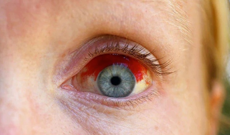 Official study says COVID jabs cause eye blindness