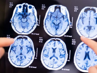 Scientists say Alzheimer’s is caused by brain fungal infection