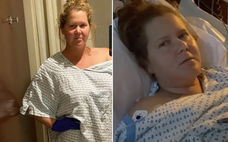 Amy Schumer reveals she developed VAIDS after getting vaccinated for COVID.