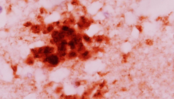 Prion disease is now transmissible due to mRNA vaccines.