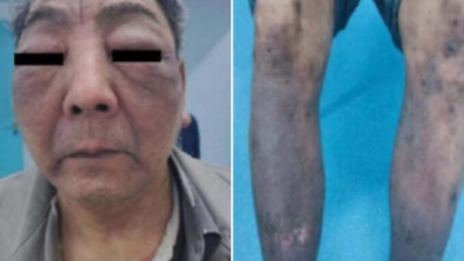 COVID jabs are causing people's skin to literally melt away, study proves.