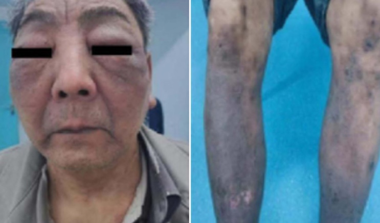 COVID jabs are causing people's skin to literally melt away, study proves.