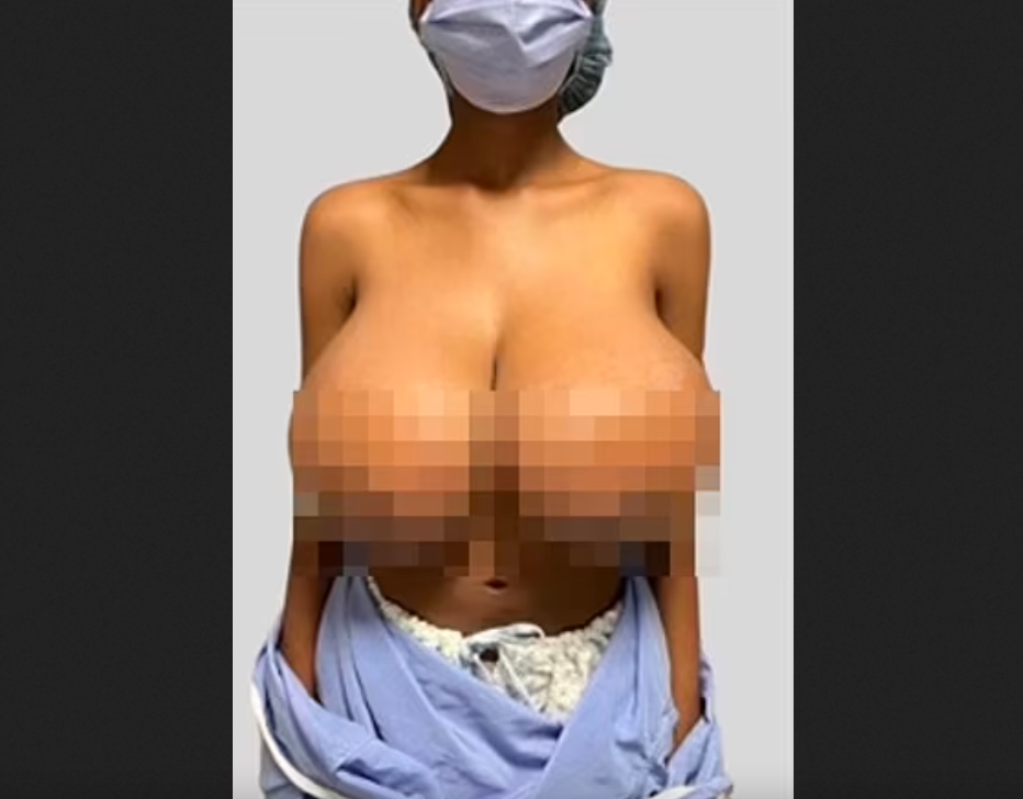 19-Year-Old’s Breasts Quadruple in Size After Pfizer COVID Vaccine Autoimmune Reaction