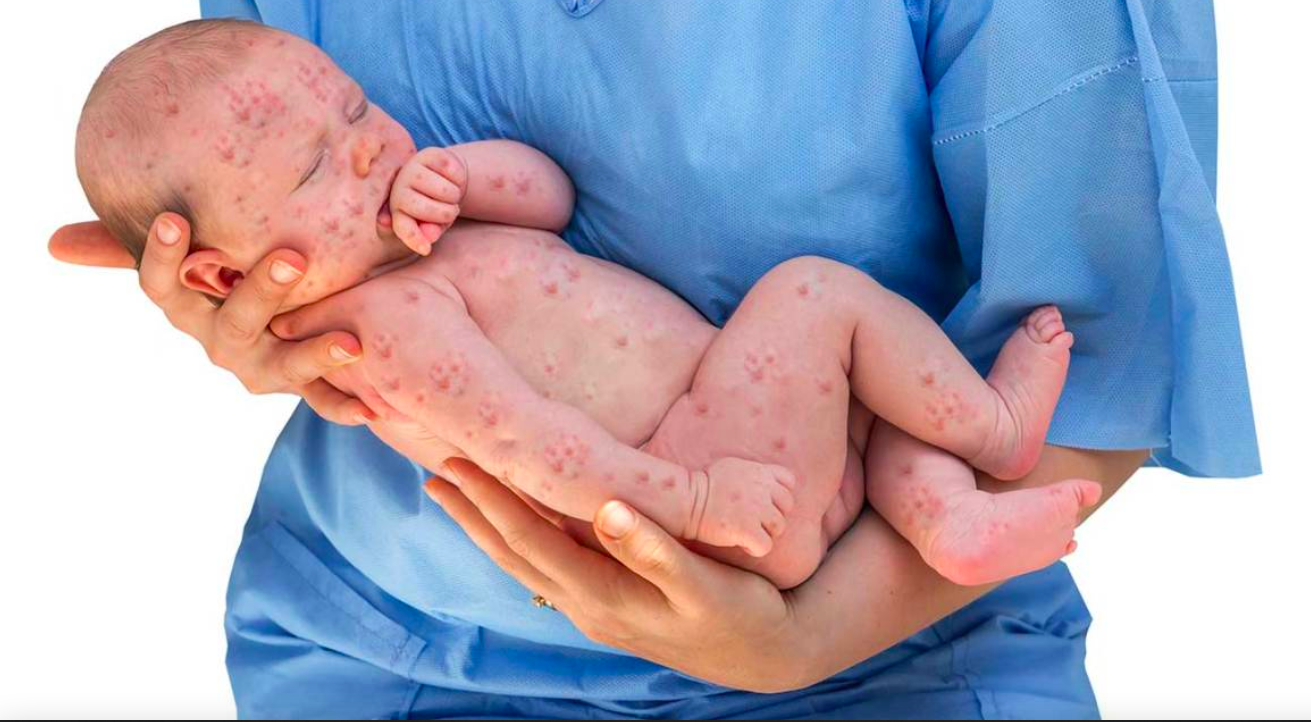 Pfizer’s COVID Vaccine Trial on Babies Covered Up Devastating Herpes Outbreaks and Brain Damage