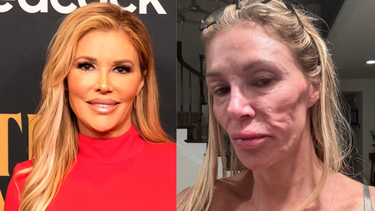 Actress Brandi Glanville Suffers Parasite Causing Facial Disfigurement After Covid Booster