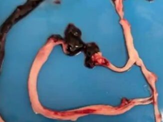 Spike protein clots detected in millions of children of vaccinated mothers.