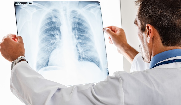 Lung Cancer Diagnoses Are Soaring in Vaccinated Non-Smokers – Doctors Baffled