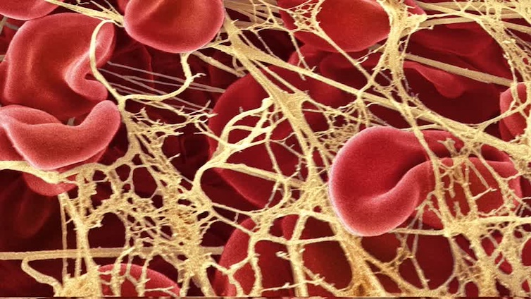 Scientists Warn Fibrous Clots Are Surging in Kids of COVID-Vaxxed Moms